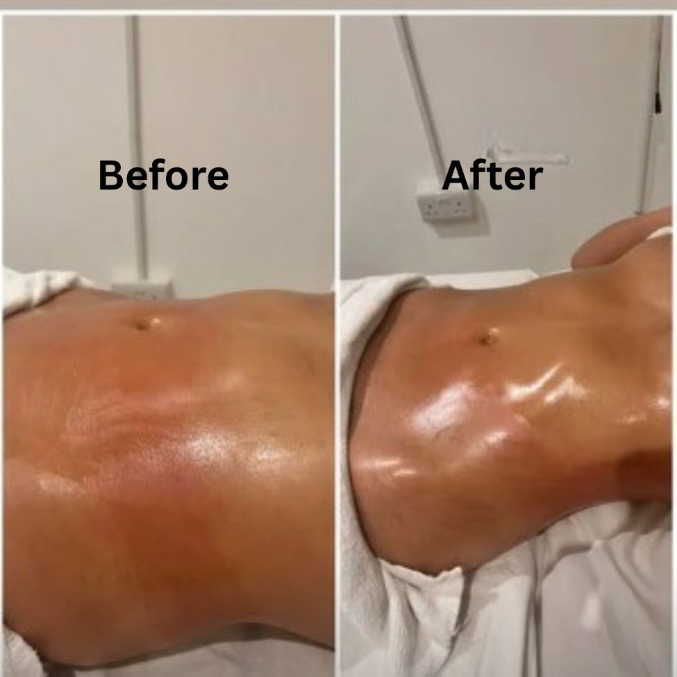 Experience professional Lymphatic Drainage Massage in Dubai with certified therapists. Same-day recovery care, detox, and 24/7 home visit services tailored for wellness and post-surgery healing.